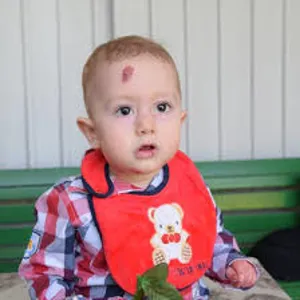 ۳۰ کودک مبتلا به «بیماری EB» در استان اذربایجان شرقی