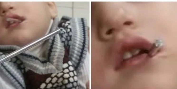 فرو رفتن میله در دهان کودک ۲ ساله